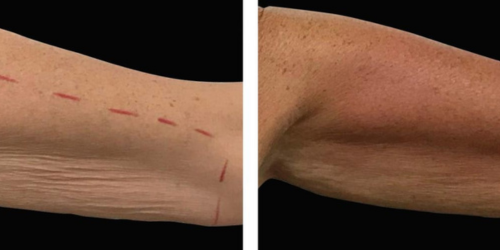 Trilipo Antes y Después