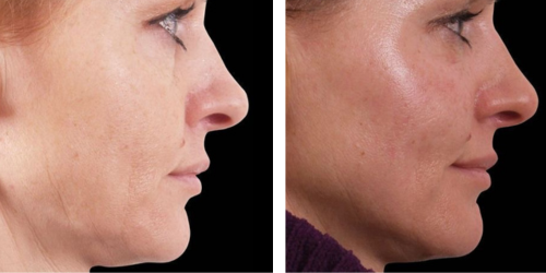 Facetone Antes y Despues