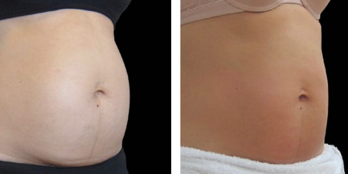 Lipoultrasonica antes y despues