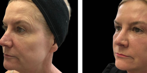 Facetone Antes y Después