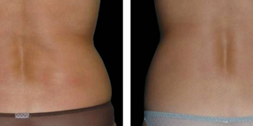 Trilipo Antes y Después