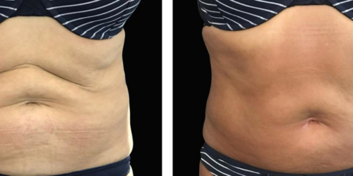 Trilipo Antes y Después