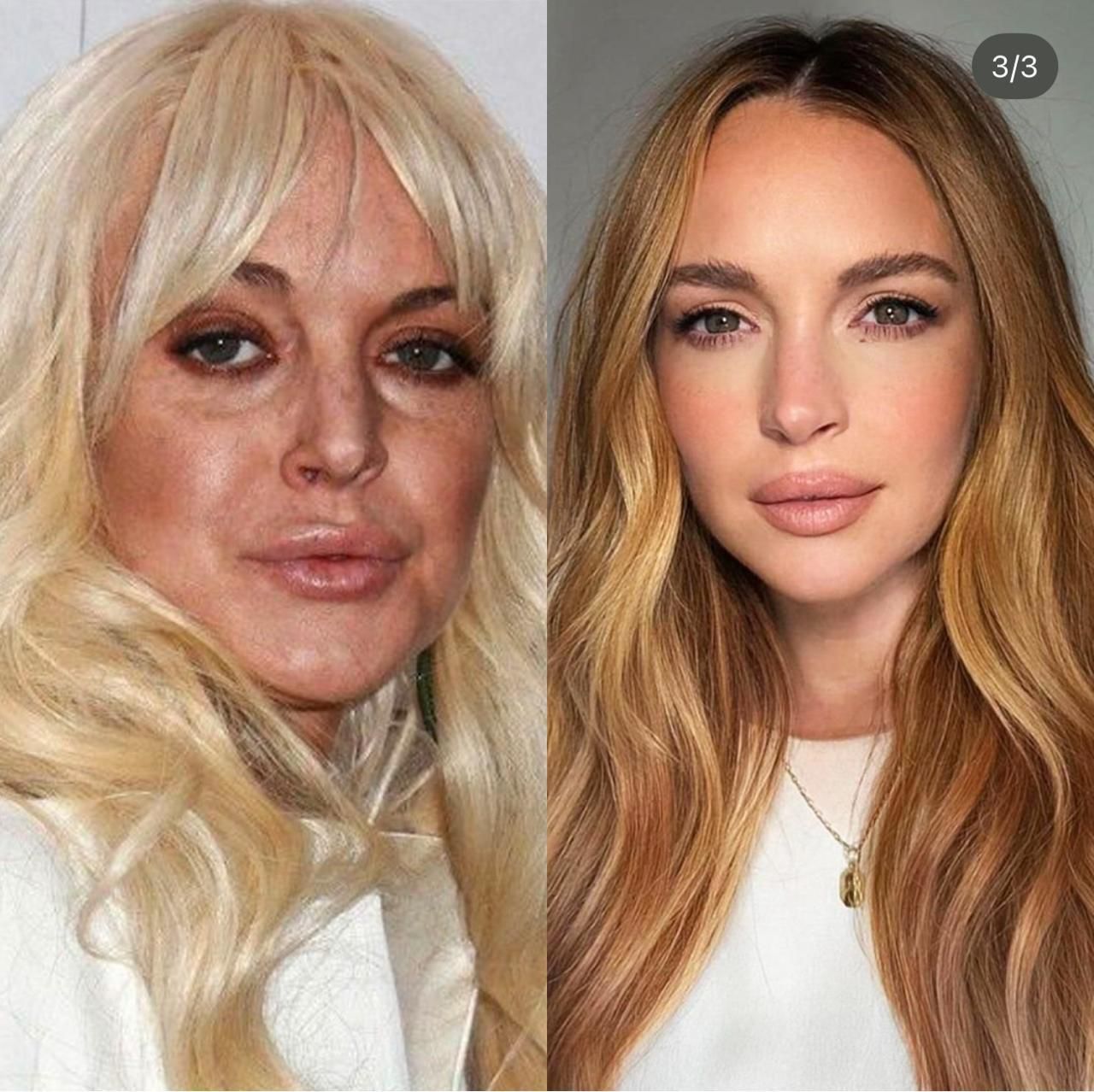 Antes Exosomas LIndsay Lohan